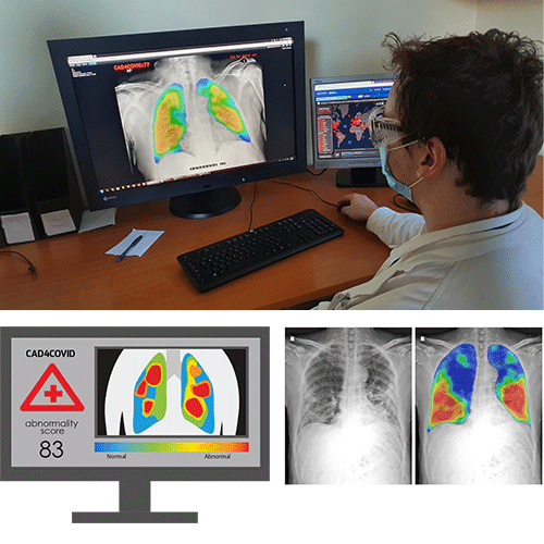 Viewing imagery of a pair of lungs on a computer monitor using the CAD4COVID CXR AI Solution