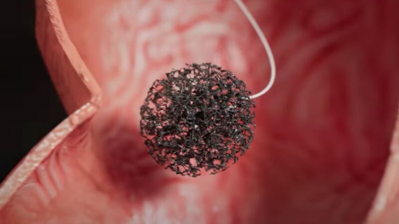 Endosign Capsule Test Screenshot From Video