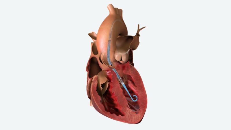 Innovative impella pump device inserted into a heart - illustration