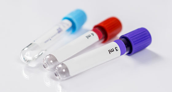 Blood or urine sample vials
