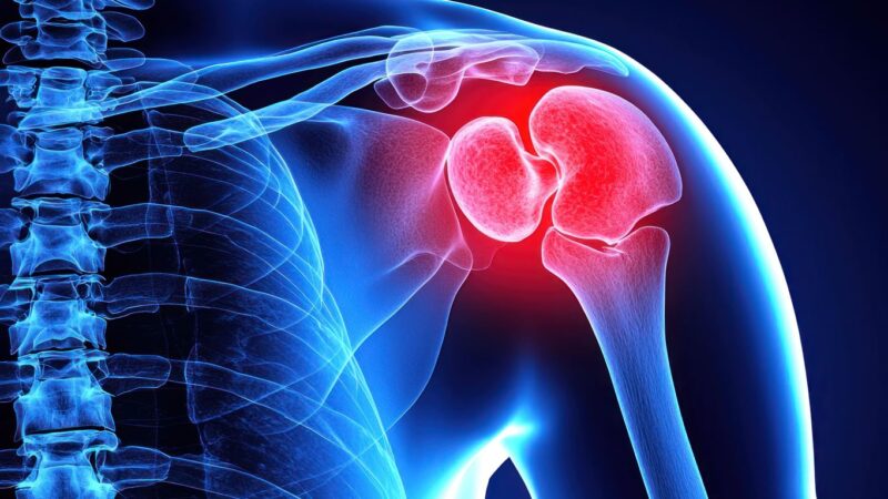 Shoulder illustration bone misalignment injury