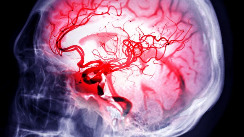 Skull image fusion MRI Scan Brain Stenosis Stroke